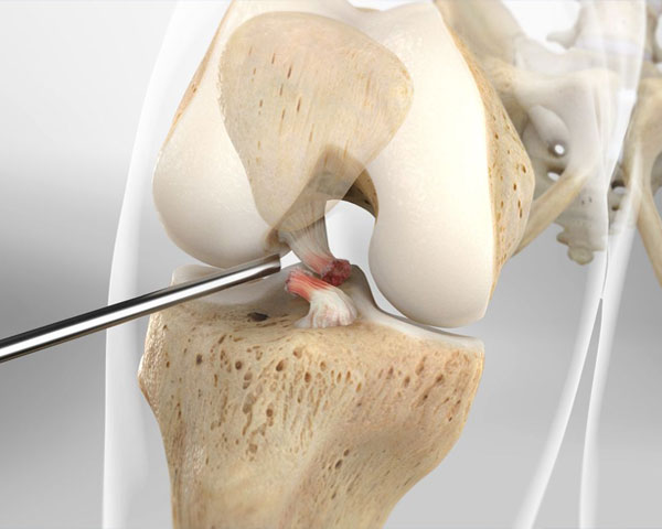 acl-repair