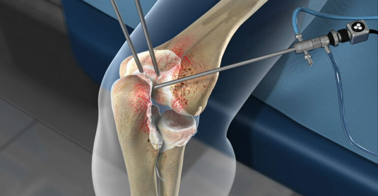 elbow-arthroscopy