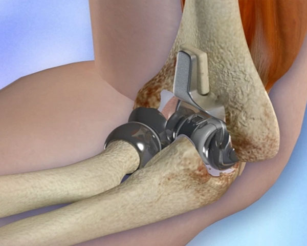 Total Elbow Replacement
