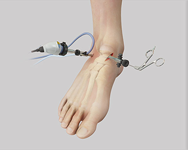 foot-and-ankle-arthroscopy