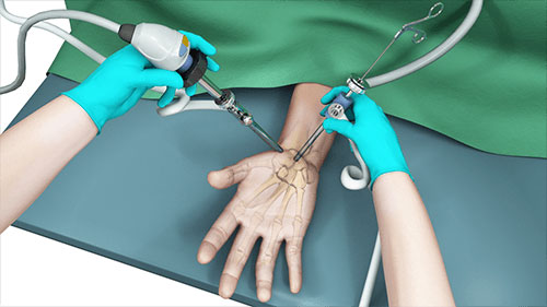 hand-wrist-arthroscopy