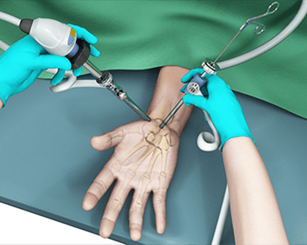 hand-wrist-arthroscopy