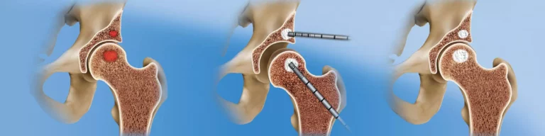 hip-arthroscopy