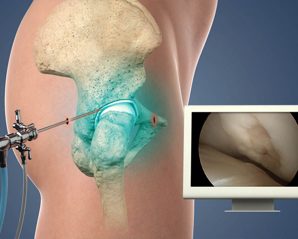 Hip Arthroscopy