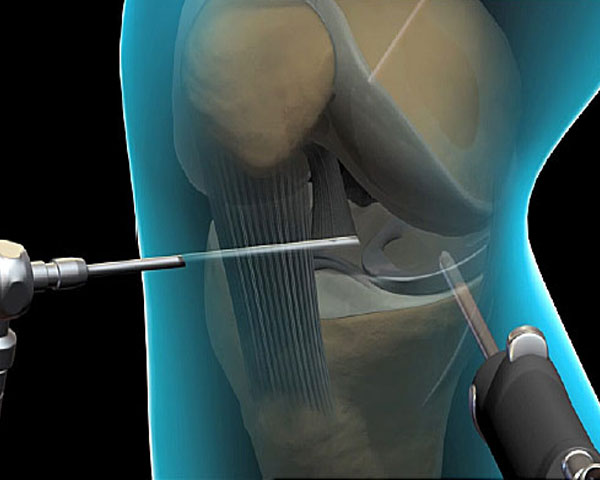 knee-arthroscopy1