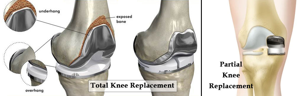 knee-replacement9