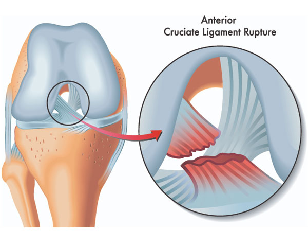 ligament-injury