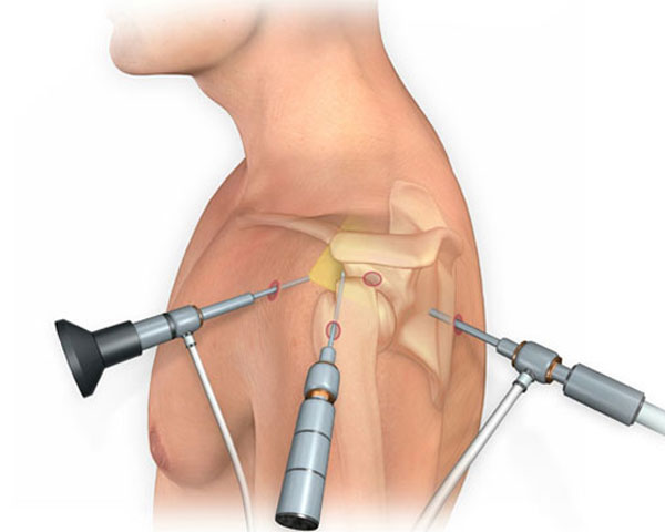 shoulder-arthroscopy