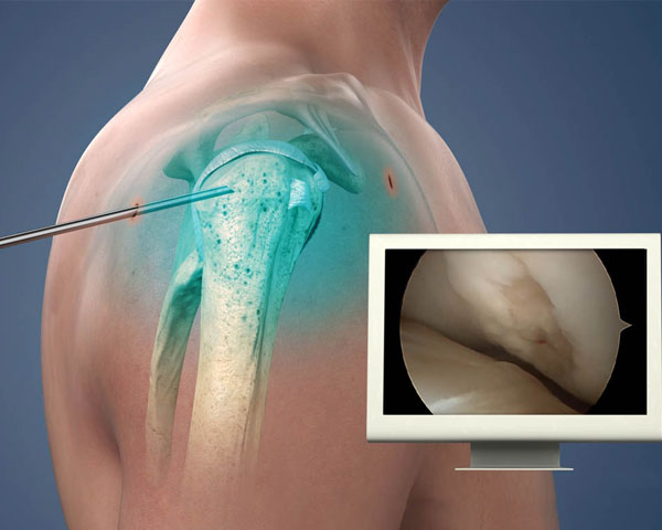Shoulder Surgery