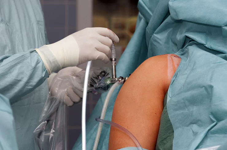 total-shoulder-replacement-surgery